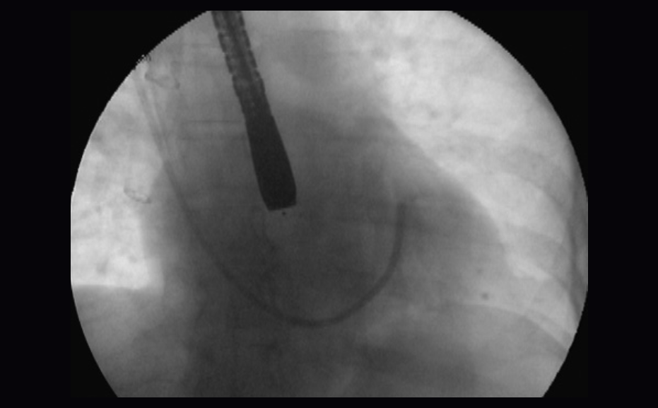 ProPlege Venogram Troubleshooting Materials